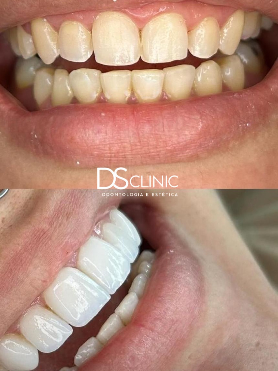 Facetas em resina: antes e depois do tratamento estético na DS Clinic Fortaleza