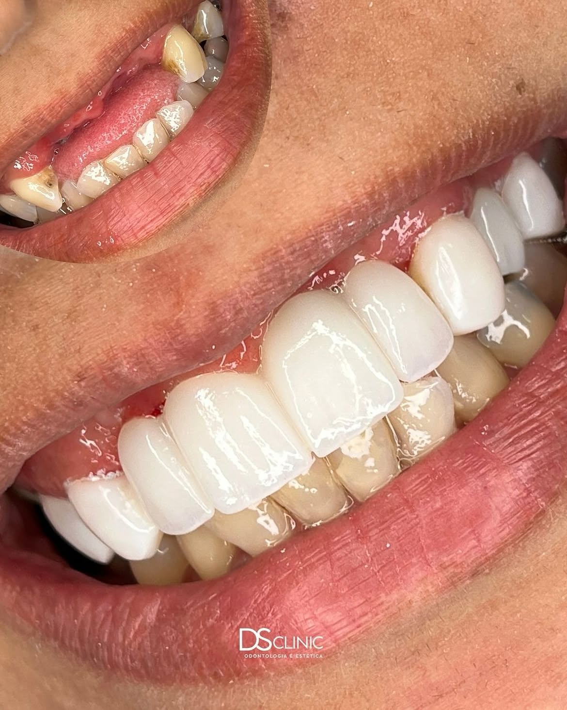 Reabilitação com implantes dentários realizada na DS Clinic Fortaleza