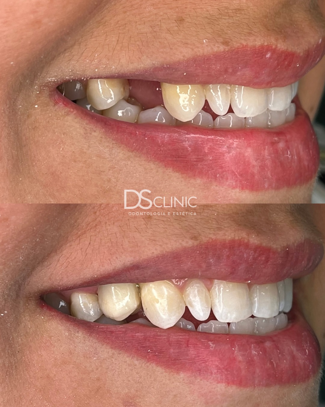 Recuperação de dente fraturado com coroa e estética dental na DS Clinic Fortaleza